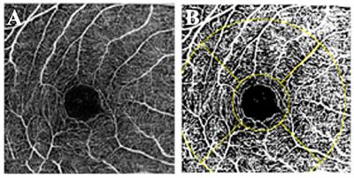 Assessment of the Macular Microvasculature in High Myopes With Swept Source Optical Coherence Tomographic Angiography